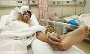 แพทย์จีนปลูกถ่ายมือที่ข้อเท้า